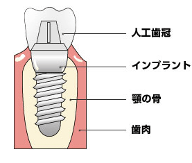 インプラント