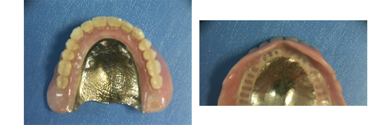 チタン床義歯作製