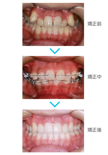 矯正治療